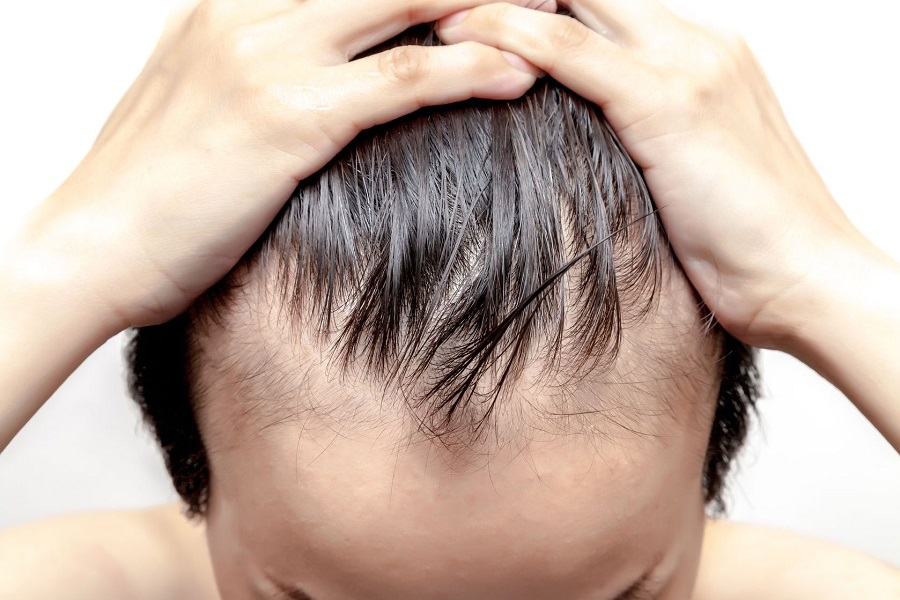 6-Signs-that-You-Are-Suffering-From-Male-Pattern-Baldness.jpg